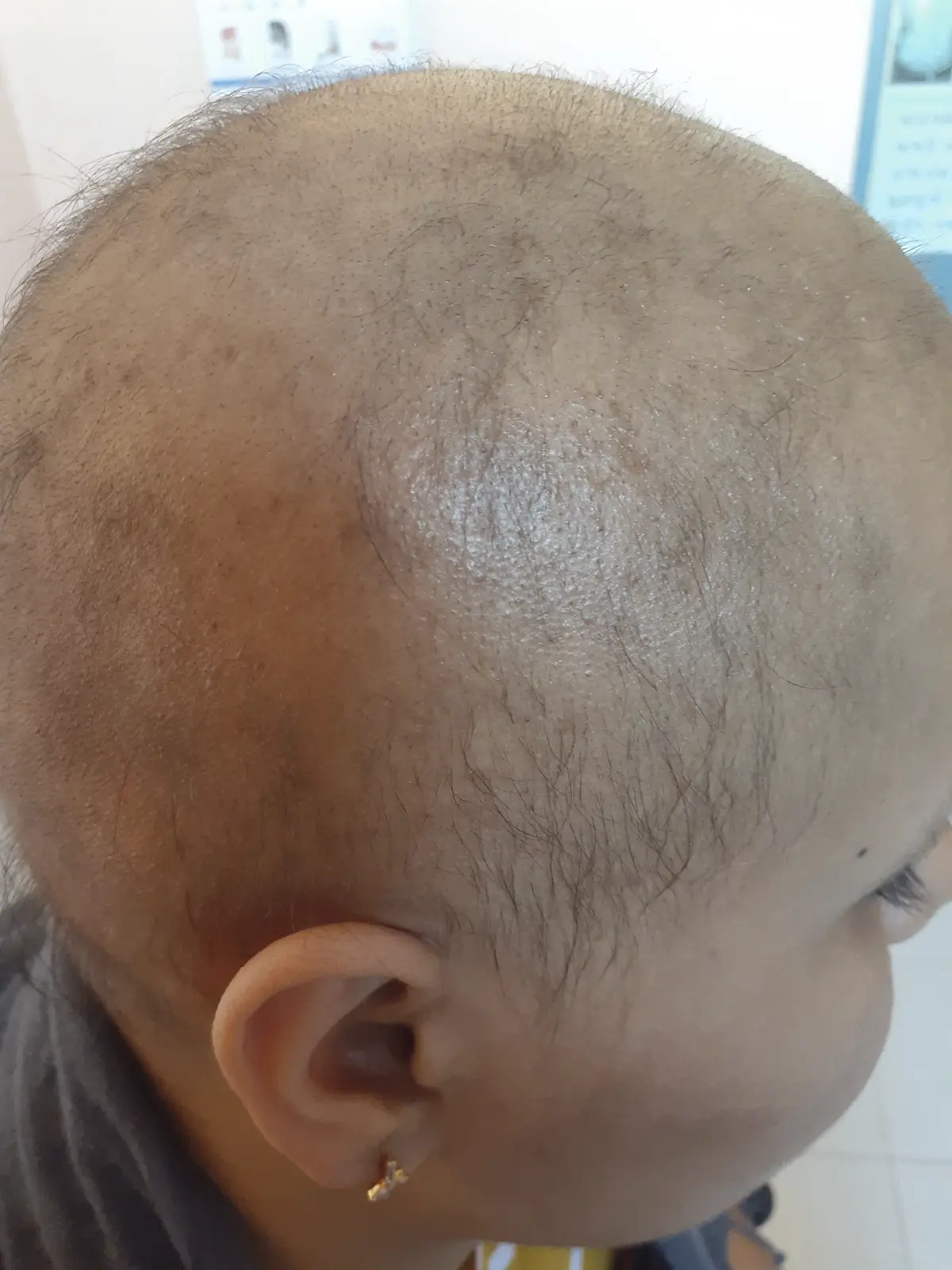 Alopecia Areata case 2 before treatment